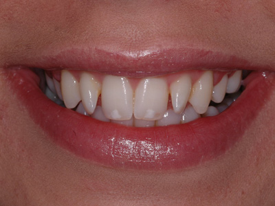 rotated lateral incisors upper arch