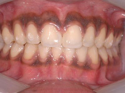 generalised spacing teeth